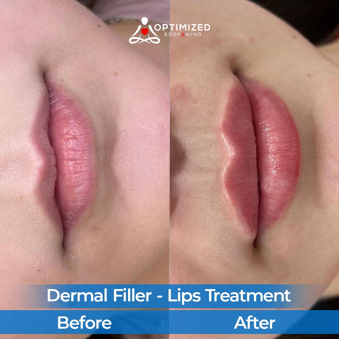 OptimizedBandM's tweet photo. Enhance your lips with trusted experts at Optimized Body &amp; Mind💉💋

💥 Limited Time Offer:
Now £𝟏𝟏𝟓 (was £190) – Get up to 40% OFF

📅 Book Your Lips Fillers Appointment Today:
👉 https://t.co/rU9hySiKDa

#optimizedbodyandmind #dermalfiller #lipfillers #luton #beforeandafter https://t.co/uQzJvxuuhj