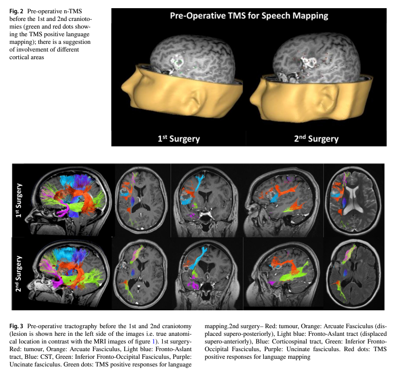 KingsNeuro's tweet photo. ☃️We have published our experience in studying "Neuroplasticity in glioblastoma: there is more to plasticity than just low-grade glioma" in @ActaNeuro 

https://t.co/iL2oVKCOAr

@saspist @lavrador_jose @dim_kalaitzo @rajwani_kapil @Sabzp87 https://t.co/FwryYidBjJ