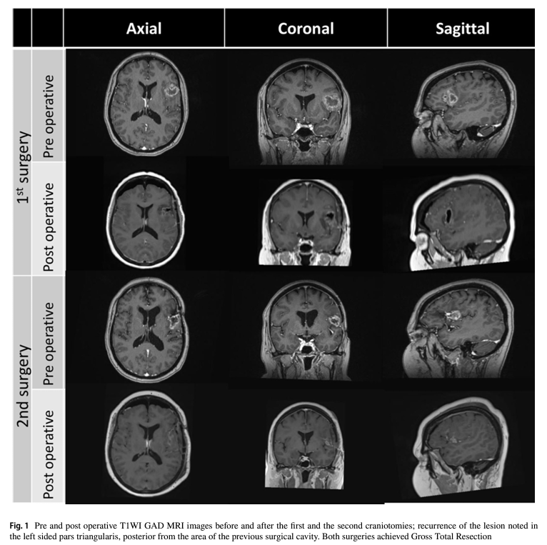 ☃️We have published our experience in studying "Neuroplasticity in glioblastoma: there is more to plasticity than just low-grade glioma" in <a href="/ActaNeuro/">Acta Neurochirurgica</a> 

rdcu.be/d3TdC

<a href="/saspist/">Sally Price</a> <a href="/lavrador_jose/">José Pedro Lavrador</a> <a href="/dim_kalaitzo/">Dimitris Kalaitzoglou</a> <a href="/rajwani_kapil/">Kapil Rajwani</a> <a href="/Sabzp87/">Sabina</a>