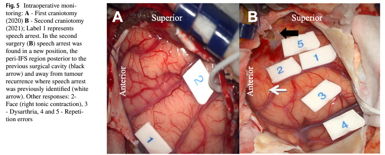 KingsNeuro's tweet photo. ☃️We have published our experience in studying "Neuroplasticity in glioblastoma: there is more to plasticity than just low-grade glioma" in @ActaNeuro 

https://t.co/iL2oVKCOAr

@saspist @lavrador_jose @dim_kalaitzo @rajwani_kapil @Sabzp87 https://t.co/FwryYidBjJ