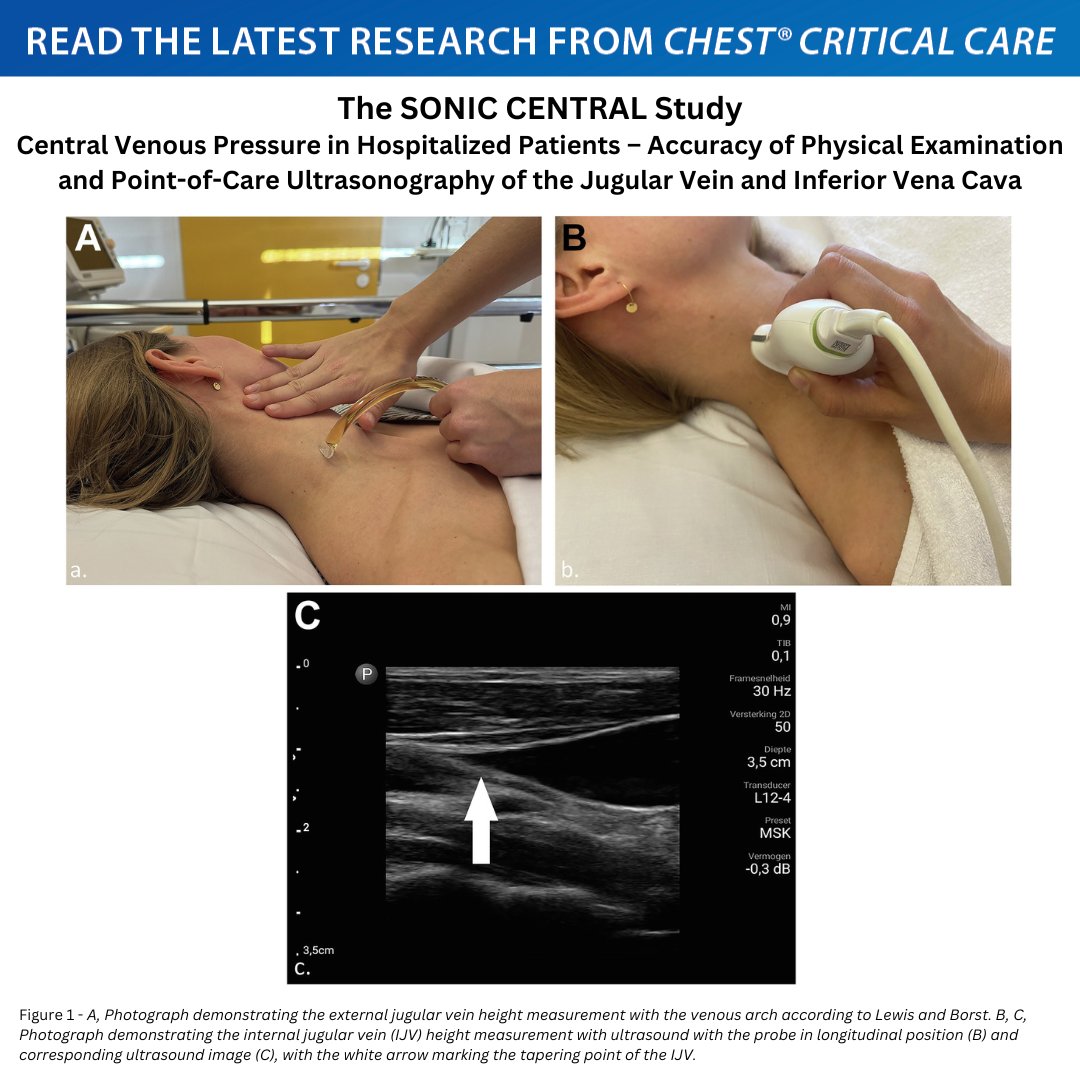 accpchest's tweet photo. Which noninvasive bedside method to estimate central venous pressure (CVP) has the best accuracy to detect elevated CVP?

Read the full research in the December issue of CHEST® Critical Care: https://t.co/ovgg9QfLtM
#MedEd #journal_CHESTCritCare https://t.co/lQeYM2qoLe