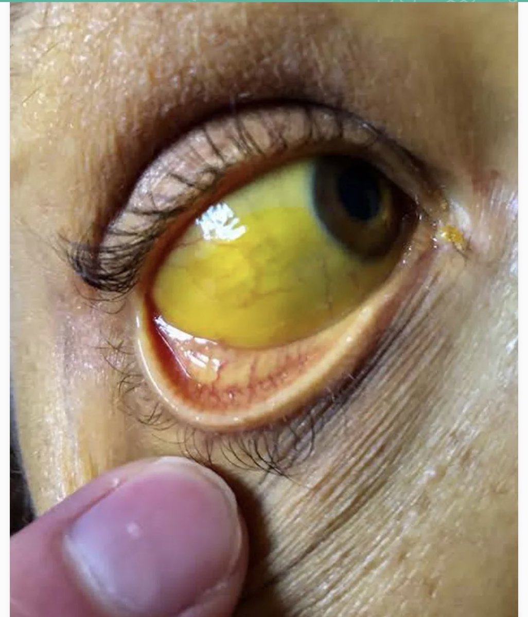 Oren Gottfried, MD tweet media