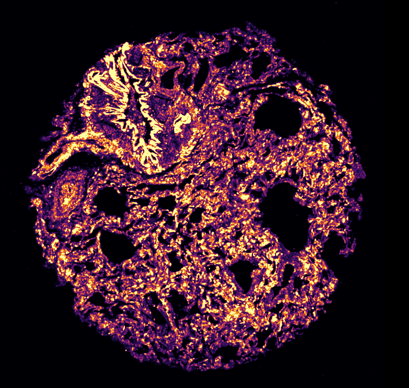 TheGregoryLab's tweet photo. This week's @10xGenomics #Xenium run out of the #DukeMGC on #colon & #lung tissue.
#SingleCells, single cells, single all the way! 🧬📷
#SpatialTranscriptomics #InSituSequencing #10xGenomics #scRNAseq #CoreFacility https://t.co/gOLf1oF8ei