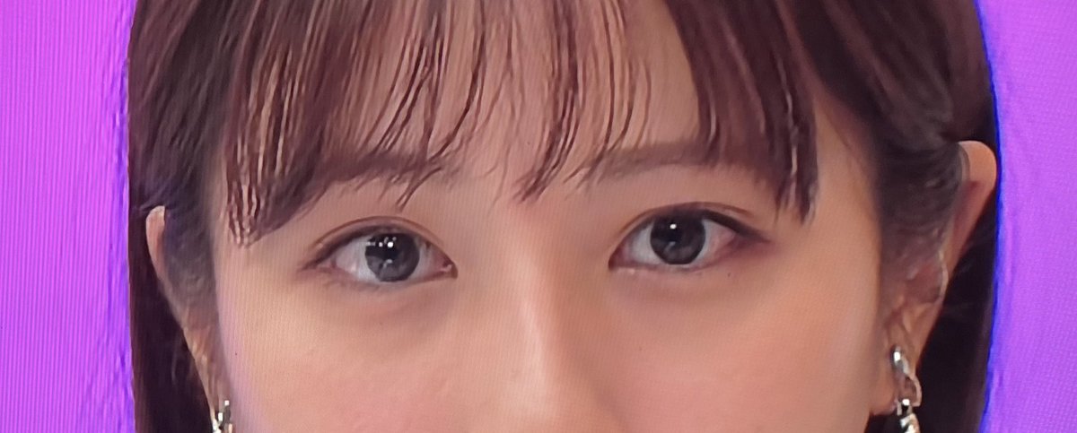 haniyama123's tweet image. ハムラ法においては剥離範囲というのは重要で、骨膜下ミッドフェイスリフトも、剥離範囲を広いものであれば、中観面の引き上げ力は高くなるが、裏ミッドフェイスリフトのような限られた剥離範囲での引き上げを目指したものですとリフティング力が無い。

#目の下のクマ