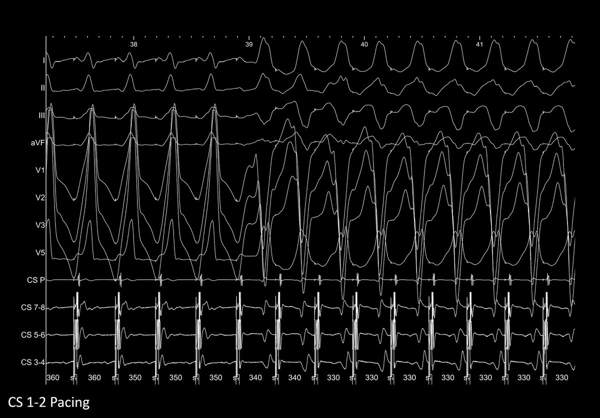 Marco Bergonti (@mbergonti) on Twitter photo 🚨 Do you want to master #Supraventricular #Tachycardia? 🎩
Follow the new #EHRA online #Course on #SVT on the <a href="/escardio/">European Society of Cardiology</a> e-learning platform 🧑🏻🏫👩🏽🏫
👉 escelearning.escardio.org/training/1701
👥 <a href="/ftrae/">Piotr Futyma, MD</a> <a href="/AriSultanEP/">Arian Sultan</a> <a href="/AndreaSarkozy/">Andrea Sarkozy</a> <a href="/LukerJacob/">Jacob Luker</a> <a href="/HH4EHRA/">Hein Heidbuchel</a> <a href="/DrV_Mann/">Christian Veltmann</a>
PS What is the diagnosis ? 🧐 🚨 Do you want to master #Supraventricular #Tachycardia? 🎩
Follow the new #EHRA online #Course on #SVT on the <a href="/escardio/">European Society of Cardiology</a> e-learning platform 🧑🏻🏫👩🏽🏫
👉 escelearning.escardio.org/training/1701
👥 <a href="/ftrae/">Piotr Futyma, MD</a> <a href="/AriSultanEP/">Arian Sultan</a> <a href="/AndreaSarkozy/">Andrea Sarkozy</a> <a href="/LukerJacob/">Jacob Luker</a> <a href="/HH4EHRA/">Hein Heidbuchel</a> <a href="/DrV_Mann/">Christian Veltmann</a>
PS What is the diagnosis ? 🧐