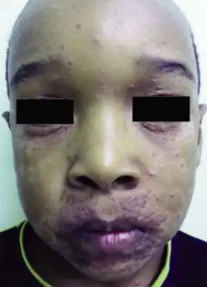 hemo_shk's tweet photo. #CGPD
What is the diagnosis?
#MEDHM #MedX @IhabFathiSulima https://t.co/H37iKpYhA4