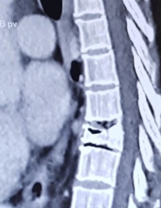 Fatales Beispiel aufgeschobener Diagnostik aufgrund einer nicht bezahlbaren Franchise. 
Erhöhung der Franchise bedeutet höheres Risiko für verspätete Tumordiagnosen und mehr Therapiekosten @Nationalrat. Sparpotential liegt hingegen im Leistungskatalog - #MutzurStraffung