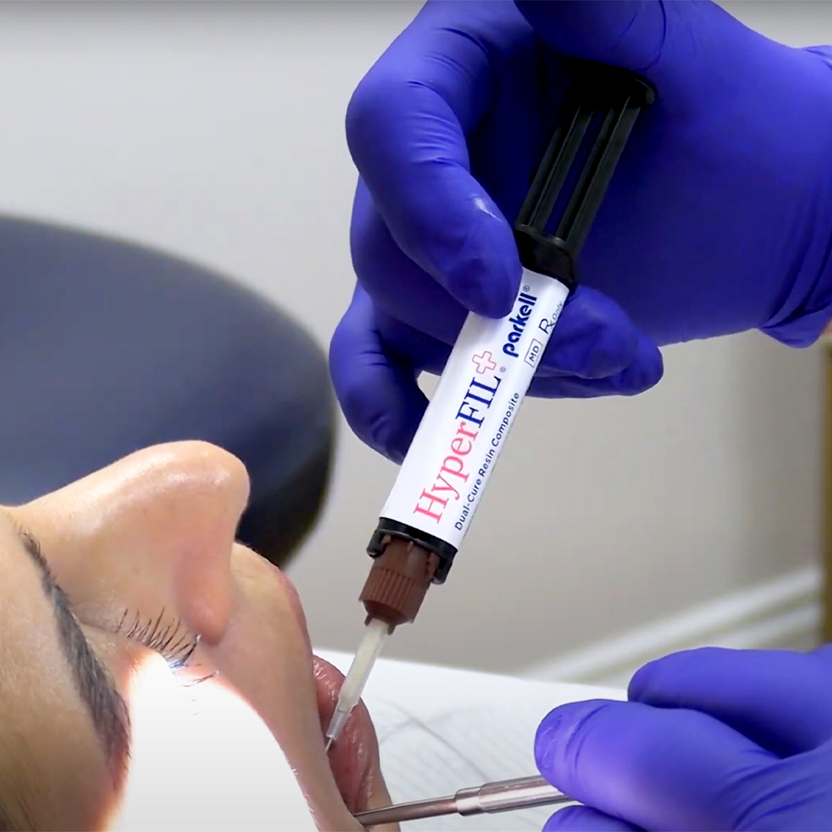 Have more confidence in your restorations with HyperFIL+! Dr. Richard Champagne notes that the combination of HyperFIL+’s dual-cure and bulk-fill capabilities makes his procedures much less stressful. youtube.com/watch?v=YiUytn…