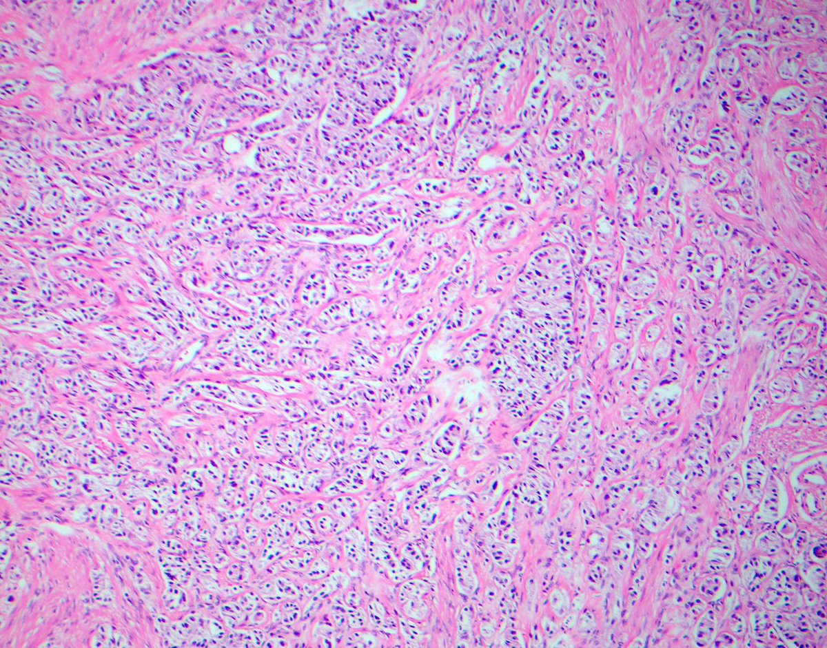 CuringN's tweet photo. Gallbladder &amp; extrahepatic bile ducts - What's your diagnosis?

Topic link: https://t.co/Zp7jGtJb8q

Images contributed by Wen-Yu Hsiao, M.D. and Haider A. Mejbel, M.D.

#Cancer #CancerResearch #CuringCancerNetwork #Pathology https://t.co/gEtaTSoZAg