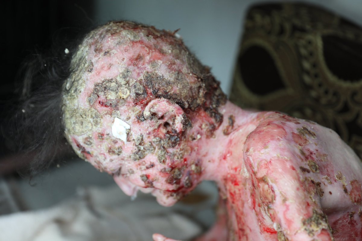 Emel Kızımıza  Baktığımda İçim Parçalanıyor 

Ailesinin Maddi Durumu Yok Bu Çocuğun Hali Ne Olacak İş Adamlarına Sesleniyorum Zengin Ünlülere Sesleniyorum Bu Kızımızın Bakımını Üstlenin 

Umarım Vicdanınız Vardır Diye Düşünüyorum İnsanlık Ölmemiştir