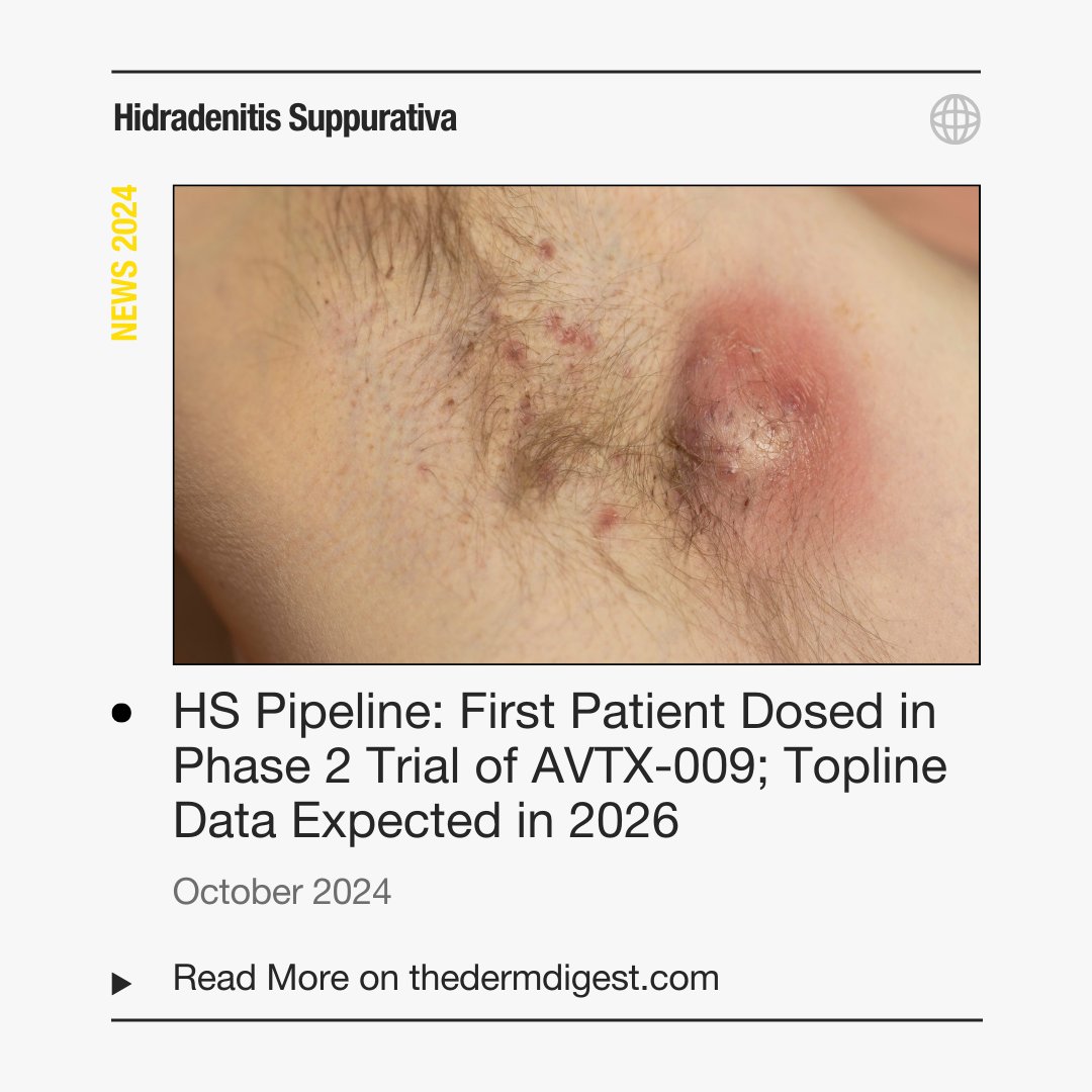 derm_digest's tweet photo. Review this year's top #HidradenitisSuppurativa headlines and breaking news with The Derm Digest. See the complete archive of HS articles: https://t.co/RknALwINuB https://t.co/oJbGvpLnIX