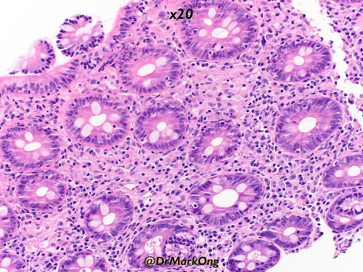 DrMarkOng's tweet photo. Patient on Ixekizumab, an anti-IL17 monoclonal antibody used in psoriasis. Colonscopy to investigate GI symptoms showed Crohn's like features.

Ixekizumab can induce IBD features:
https://t.co/wEcjj4aNF7

#GIpath #pathology https://t.co/gRNKEPonGw