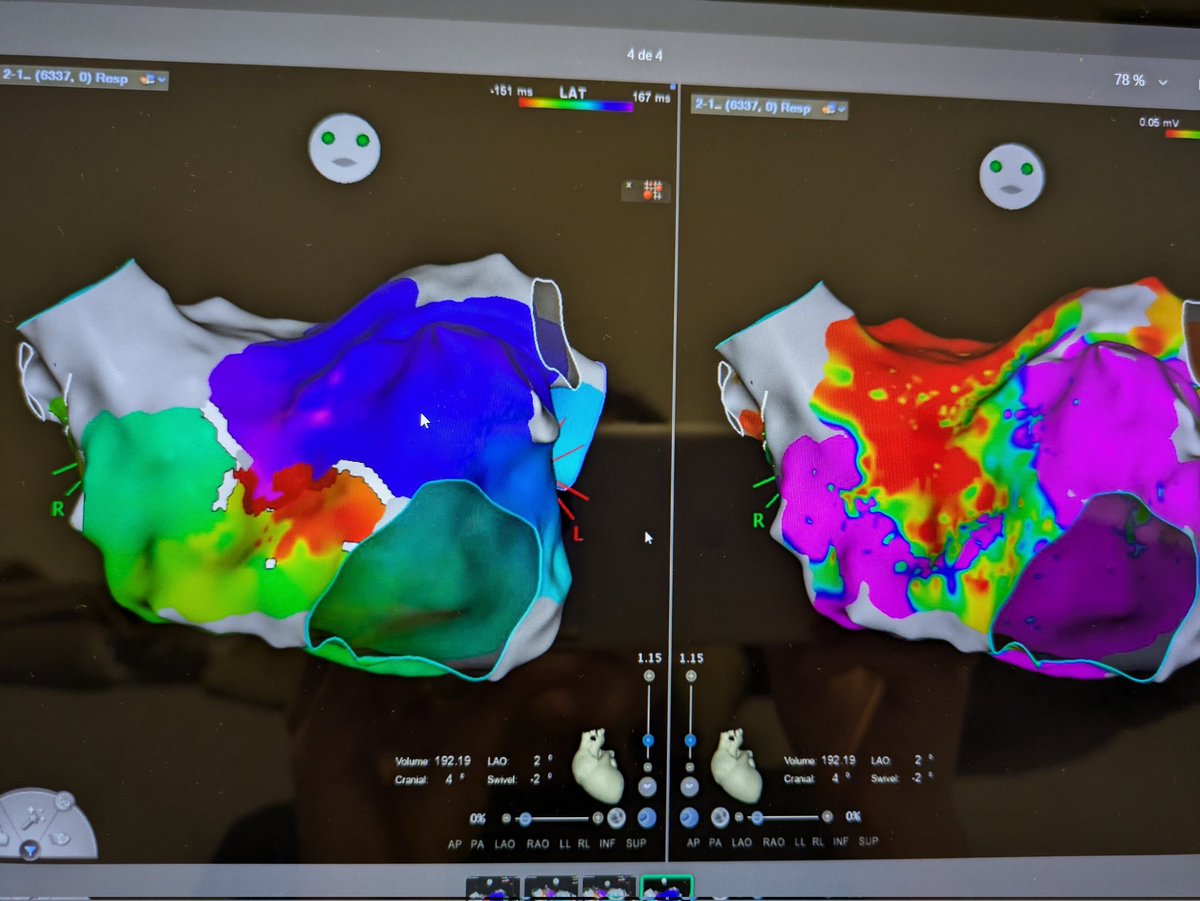 tebagf's tweet photo. There are few feelings in EP more satisfying than interrupting an atypical flutter with the first application. Thank to the masters for their assistance!
 #IvanCarto @calvarezo_ https://t.co/raG7w9pOin