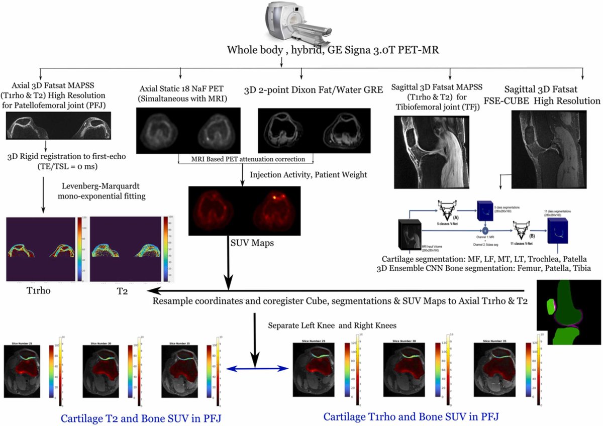 Osteoarthritis and Cartilage Journals (@oacjournal) on Twitter photo Association patterns were identified in PFJ-OA subjects between subchondral bone SUV, cartilage, T1p and T2 in trochlear and patellar, medial, and lateral regions and vertical GRF loading rates. <a href="/Rupsa_B/">Rupsa Bhattacharjee, PhD</a> <a href="/sharmilamajumda/">Sharmila Majumdar</a> <a href="/PedoiaValentina/">Valentina Pedoia</a> <a href="/richsouza_ucsf/">Richard Souza</a> ๐ buff.ly/3CTHXaR Association patterns were identified in PFJ-OA subjects between subchondral bone SUV, cartilage, T1p and T2 in trochlear and patellar, medial, and lateral regions and vertical GRF loading rates. <a href="/Rupsa_B/">Rupsa Bhattacharjee, PhD</a> <a href="/sharmilamajumda/">Sharmila Majumdar</a> <a href="/PedoiaValentina/">Valentina Pedoia</a> <a href="/richsouza_ucsf/">Richard Souza</a> ๐ buff.ly/3CTHXaR