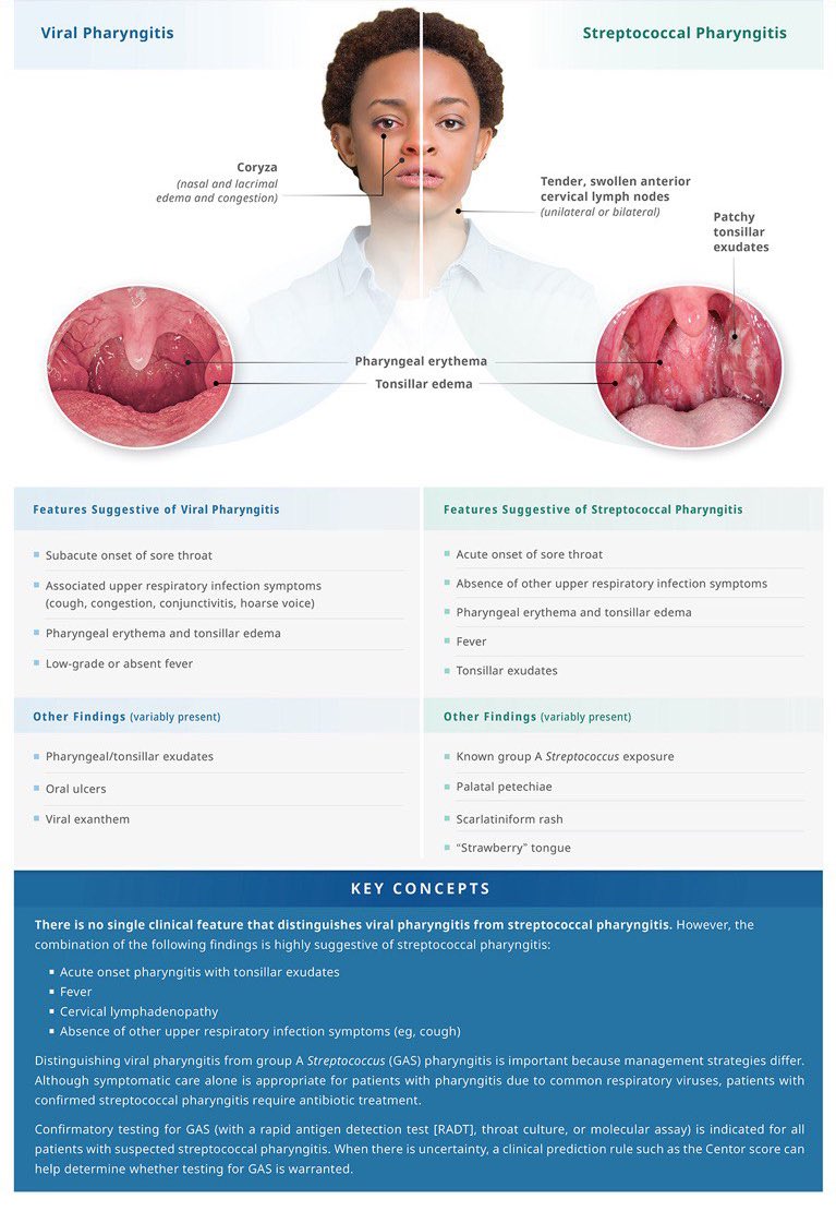 Viral pharyngitis v/s Streptococcal pharyngitis

From UpToDate