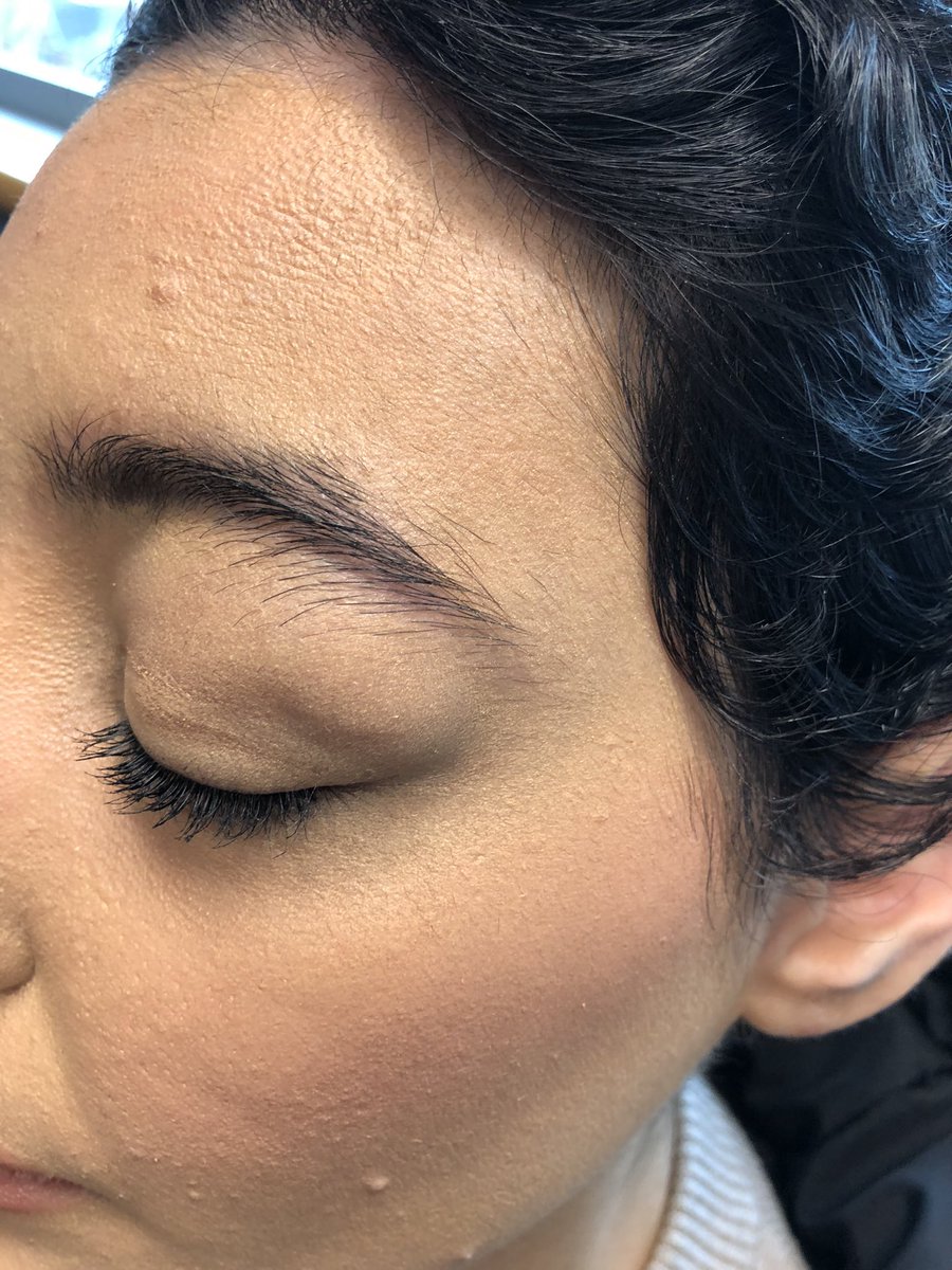 Janetbirdope's tweet image. Here is a tough one…

#Diagnosis in 2 #pictures

#ClinicalPearl 

hint #immunoglobulins should be ordered 

#MedEd #MedX #RheumEd #RheumX