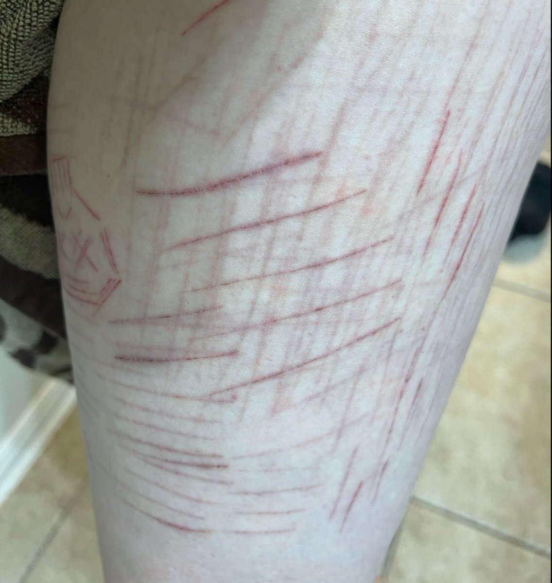infernock17's tweet photo. scar progression after 8 months i think it looks a lot better now🎉 https://t.co/AwnMC9frje