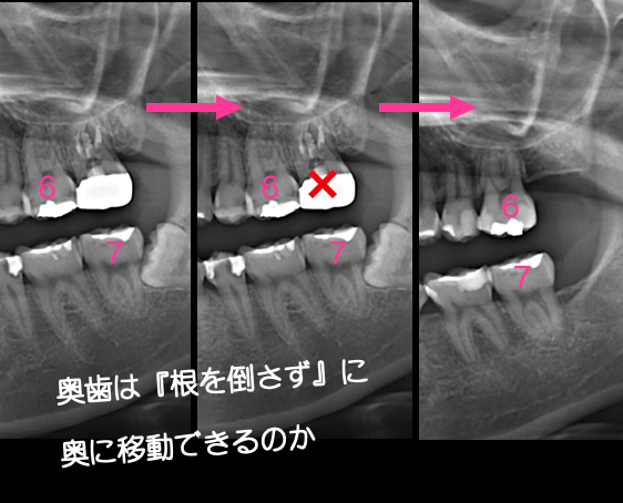 dds_cozy's tweet image. 上の奥歯をさらに奥に
『根っこを倒さず真っ直ぐに』移動できるか？？
は、これで４−５mmくらいでしょうか。

インプラントアンカーを
ワイヤー交換のようにサクサク入れて、動かします。