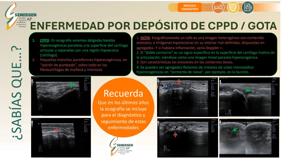 💡#EcoSabíasQué #EcoDato de #GTEcoSemergen 
¿Conoces los principales hallazgos de la enfermedad por depósito de CPPD?
#Ecoactualizate #ultrasound #atencionprimaria #paciente