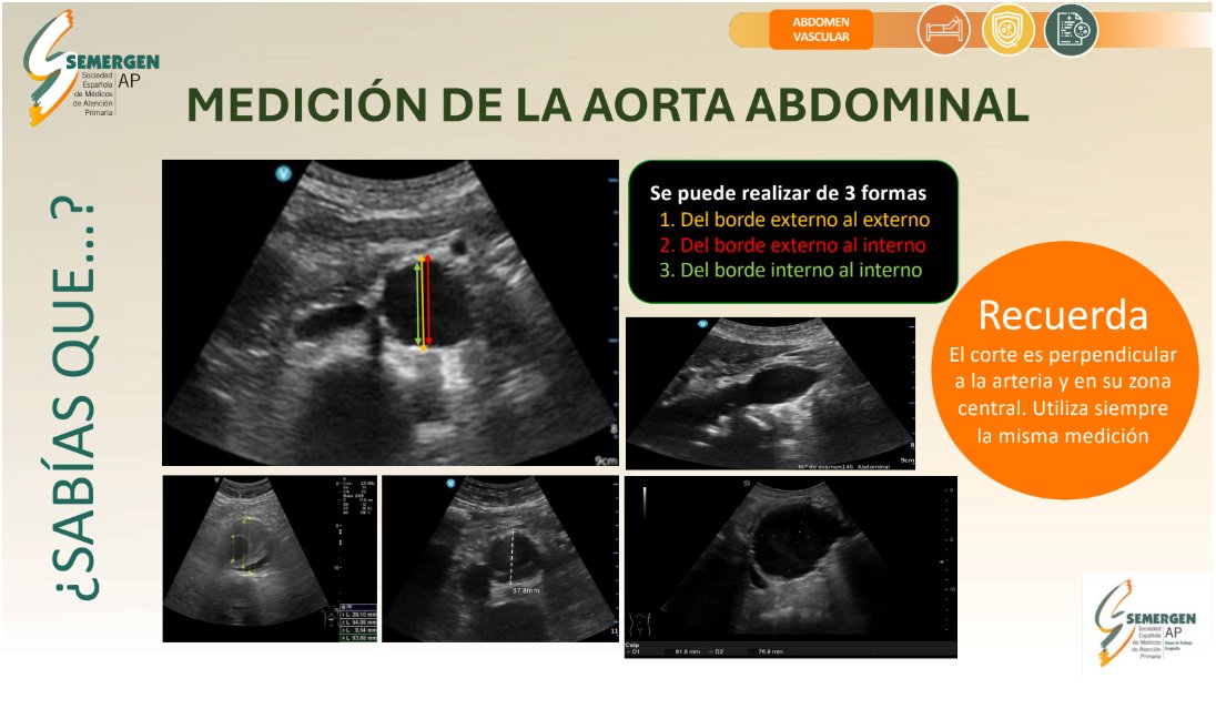 💡#EcoSabíasQué #EcoDato de #GTEcoSemergen 
¿Hay varias formas de realizar la medición de la AA?

#Ecoactualizate #ultrasound #atencionprimaria #paciente