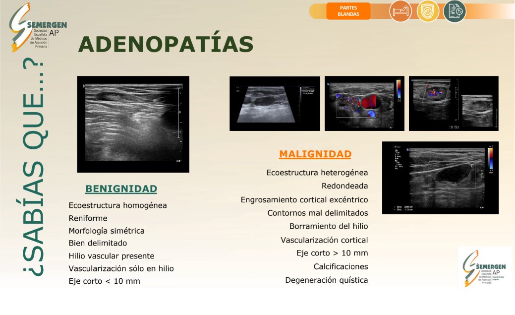💡#EcoSabíasQué #EcoDato de #GTEcoSemergen
¿Conoces las principales características que diferencian una adenopatía normal de una patológica?

#Ecoactualizate #ultrasound #atencionprimaria #paciente