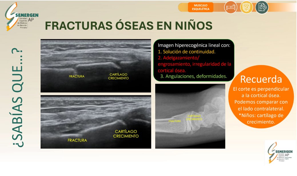 💡#EcoSabíasQué #EcoDato de #GTEcoSemergen
¿Sabrías diferenciar una fractura del cartílago de crecimiento en un niño?
#Ecoactualizate #ultrasound #atencionprimaria #paciente