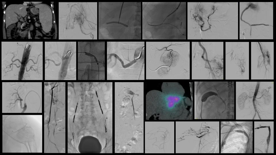 Kara Fitzgerald, MD (@kmfitzmd) on Twitter photo Interventional radiology — every day a new skill, every case a chance to innovate, every consult a patient to help. Block 4 of PGY-6 flew by.... #IRAD #IRadRes <a href="/UofWa_IR/">University of Washington IR Residency</a> Interventional radiology — every day a new skill, every case a chance to innovate, every consult a patient to help. Block 4 of PGY-6 flew by.... #IRAD #IRadRes <a href="/UofWa_IR/">University of Washington IR Residency</a>