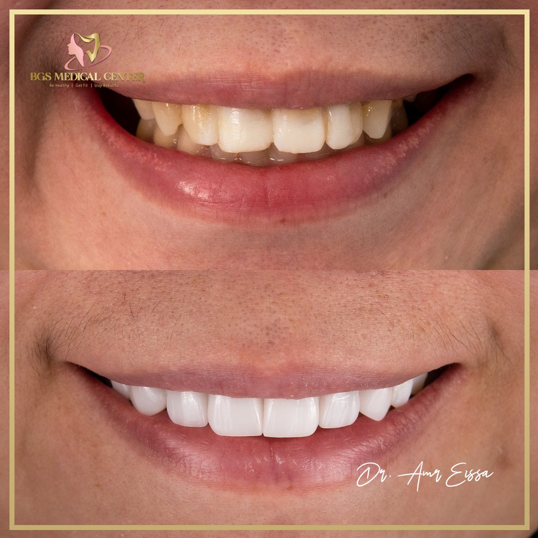BgsMedical's tweet photo. Expertly crafted by Dr. Amr Eissa at BGS Medical Center, this Hollywood Smile makeover combines precision, artistry, and care to deliver flawless.

📞 +971 52 235 9090
🌐 https://t.co/noJiMmOCcO
.
.
#HollywoodSmile #DrAmrEissa #SmileMakeover #BGSMedicalCenter #ConfidenceRestored https://t.co/6Yl05UcIan