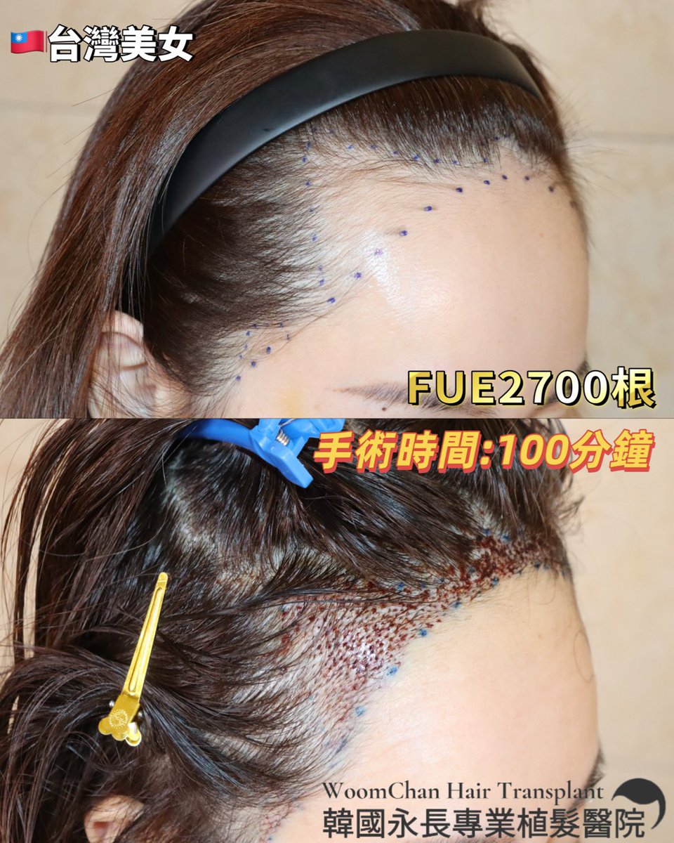 lee910907's tweet photo. 台灣過來的美女調節髮際線到鬢角
​FUE2700根，手術時間100分鐘
​類似情況🉑參考啊
​手術時間根據毛囊狀態略有不同⚠️
​咨詢隨時🉑滴滴我們
微信/  line👉woomchan
whatsapp: +821097895827
https://t.co/IWnWgwD2kc
 #韓國免剃髮植髮 #永長植髮 #woomchan永長植髮 #韩国植发医院 #韩国植髮費用 #FUE植髮 https://t.co/cuYrohS0l4