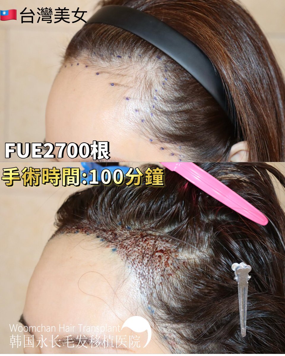 lee910907's tweet photo. 台灣過來的美女調節髮際線到鬢角
​FUE2700根，手術時間100分鐘
​類似情況🉑參考啊
​手術時間根據毛囊狀態略有不同⚠️
​咨詢隨時🉑滴滴我們
微信/  line👉woomchan
whatsapp: +821097895827
https://t.co/IWnWgwD2kc
 #韓國免剃髮植髮 #永長植髮 #woomchan永長植髮 #韩国植发医院 #韩国植髮費用 #FUE植髮 https://t.co/cuYrohS0l4