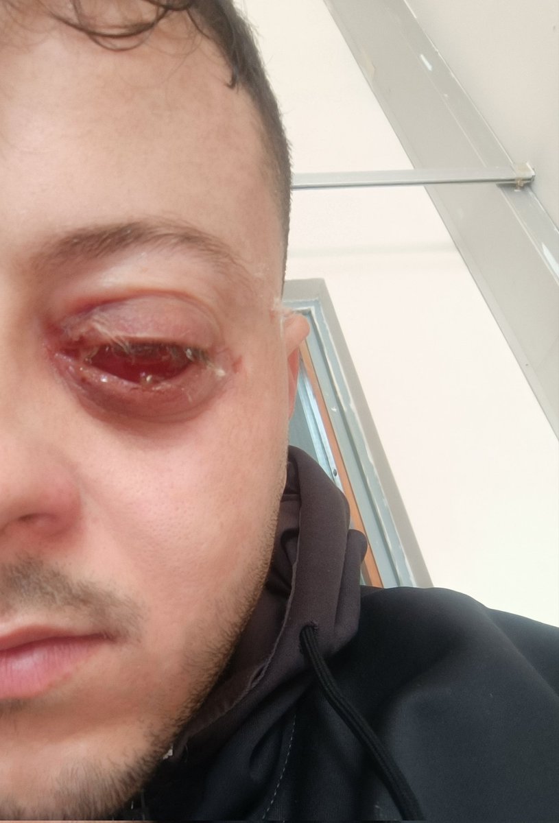 My eye after the doctor removed it. 

Shall you please pray for me.
gofund.me/3fd33d14