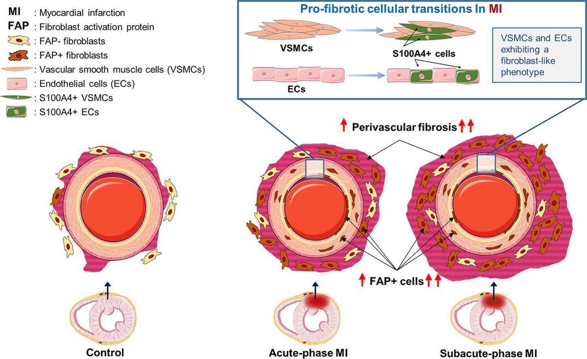 JMCC Plus (@jmccplus) on Twitter photo In our December issue, fantastic research by Jiang et al. (<a href="/amsterdamumc/">Amsterdam UMC</a>) highlights how perivascular #fibrosis in intramyocardial blood vessels may play a key role in #myocardialinfarction (#MI) progression.
Read more here: buff.ly/4gjD7Tf In our December issue, fantastic research by Jiang et al. (<a href="/amsterdamumc/">Amsterdam UMC</a>) highlights how perivascular #fibrosis in intramyocardial blood vessels may play a key role in #myocardialinfarction (#MI) progression.
Read more here: buff.ly/4gjD7Tf
