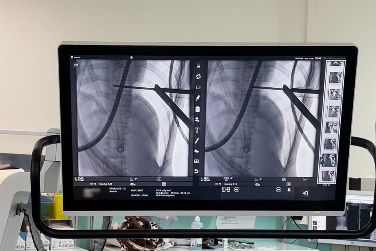 Première utilisation du #PediGuard fileté lors de chirurgies #VBT à l’hôpital HFME de Lyon avec les Dr. Brice Henry et Matthieu Baudoux !

Le PediGuard a permis :
✅ Un placement bi-cortical sécurisé de vis vertébrales
✅ La détermination précise de la longueur de vis

#scoliose