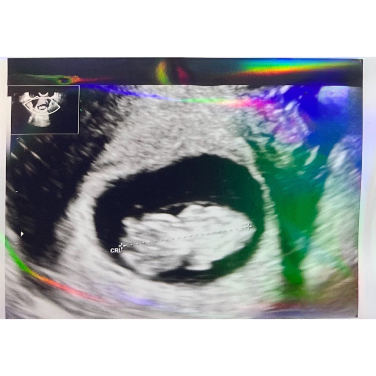 ご報告です。
新しい命を授かりました👶🏻
それと同時にばんばんざいを卒業します。
沢山の意見があると思いますが
インスタの方に詳しく文章で
載せていますので、
チェックしてもらえると嬉しいです
今はまだ安定期に入っておらず
凄いリスクではありますが
まずは健康第一で頑張りたいと思います。