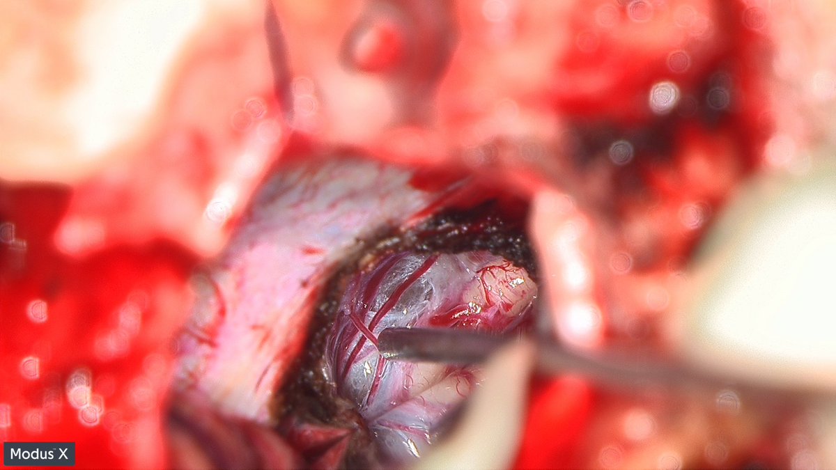 SynaptiveMed's tweet photo. “Synaptive’s latest exoscope, Modus X, provides enhanced tissue differentiation with its improved coloring technology and is sharper and more detailed than what I can see with my own eyes. 
Dr. Sunil Patel, Chair of Neurosurgery, @MUSChealth https://t.co/gx8EXssfSq
