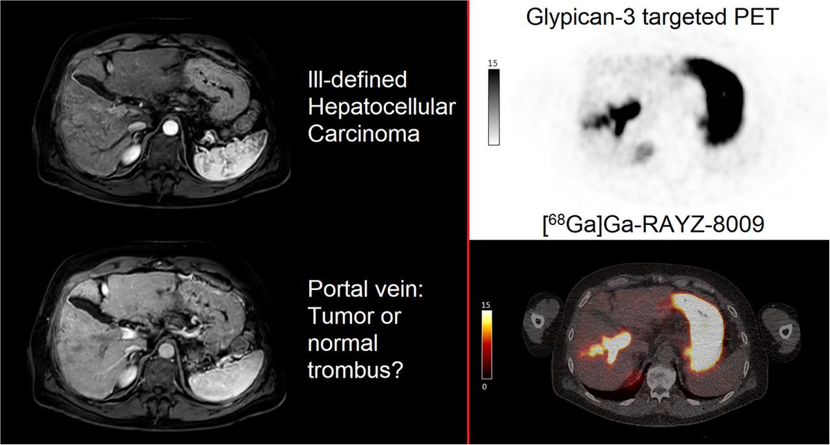 JournalofNucMed's tweet image. ⁶⁸Ga-RAYZ-8009 is safe and allows for high-contrast imaging of GPC3-positive hepatocellular cancer. ow.ly/hwmq50UeQTm

#NuclearMedicine #MolecularImaging #HCC @MatthiasEiber @molecmedtweet