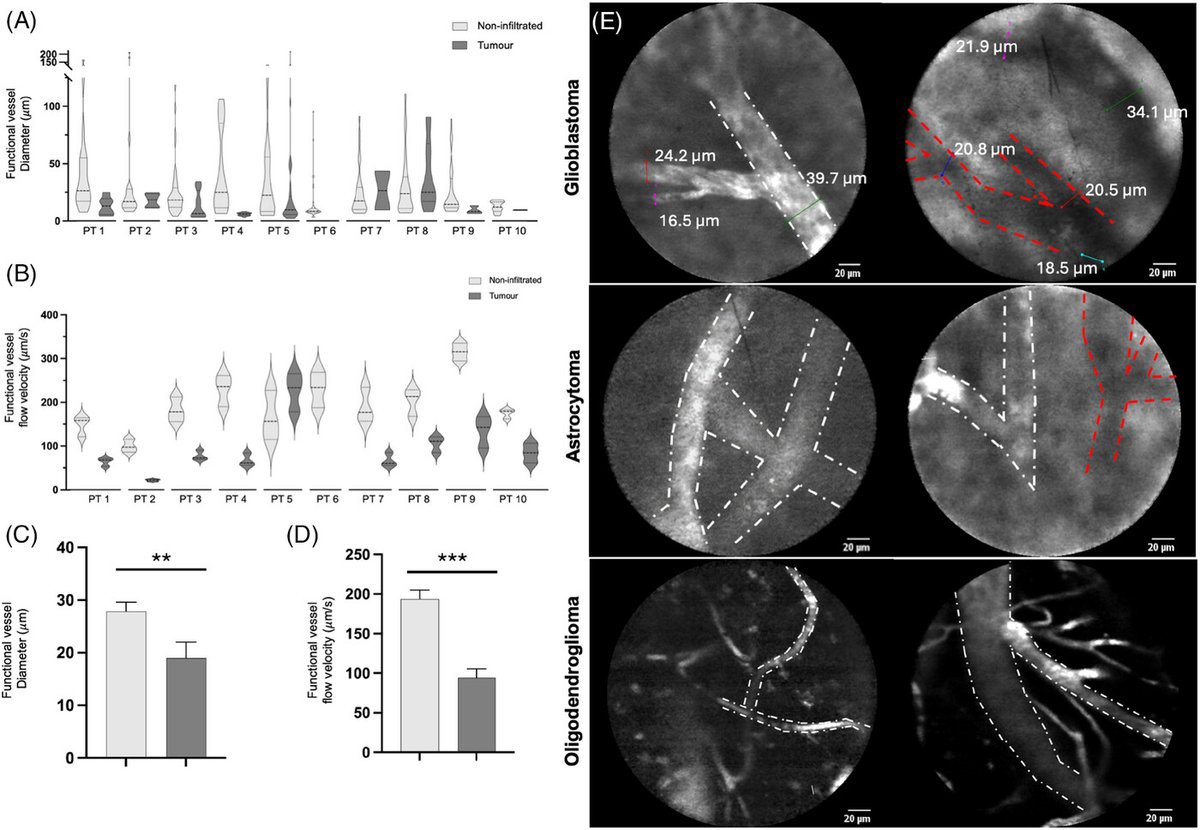 Direct real-time intra-operative imaging of HUMAN Brain tumor vessels using #IntravitalMicroscopy
N=10 

Fluorescein (AK-FLUOR) i.v.

Confocal laser endomicroscopy <a href="/maunakeatech/">Cellvizio® by Mauna Kea Technologies</a>

🧠Tumors vs Adjacent non-tumor regions
👉30% ⏬vessel diameter
👉50%⏬flow velocity
👉No gross vessel