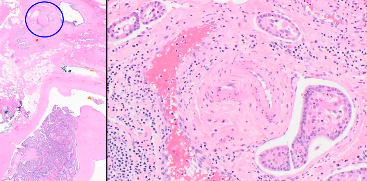 Janiranavarro's tweet photo. Breast Pathology-Pitfalls

-Displaced epithelium can go to lymphatics (rare)
-Index lesion is an intraductal papilloma

Dr. Lerwill CCSP24 #PathX #BreastPath