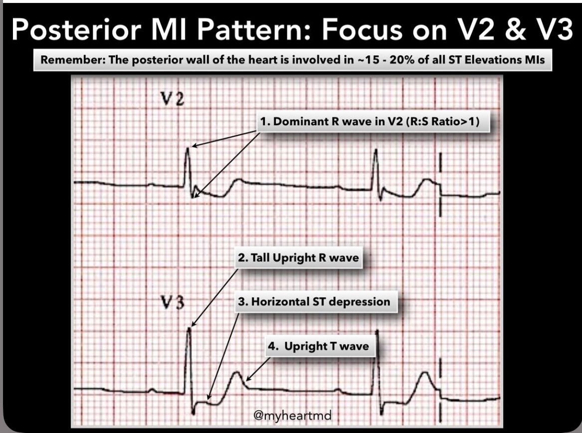 DrMedica_13's tweet photo. Posterior Wall MI 🫀💥

🧶🧶🧶
#MedEd #MedX #CardioMed https://t.co/2xvhFDdf1D