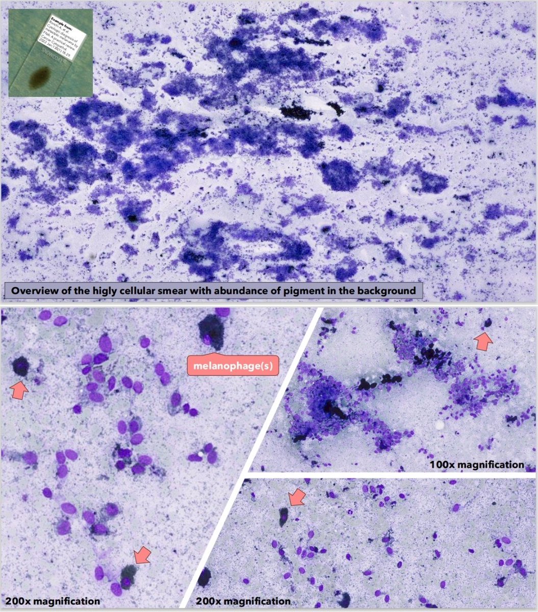 zivaledinek's tweet image. My today's presentation 👩🏼‍🏫 at a Slide Seminar of a difficult #cytology case (I performed the FNA 💉 myself). This was a 21-year-old female patient with a soft tissue lesion behind a lateral malleolus #PathX #PathTrainee What do you think? ⬇️