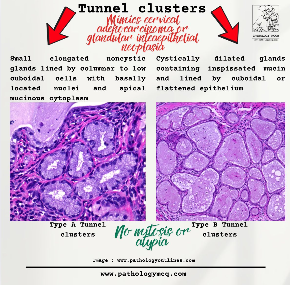 Pathology_mcqs's tweet photo. 🔍 Tunnel Clusters: Benign cervical glandular changes that can mimic cervical adenocarcinoma or glandular intraepithelial neoplasia (GIN)! 🧪
Type A shows noncystic glands with basally located nuclei, while Type B displays cystically dilated glands containing mucin. https://t.co/zoiYCb8nUO