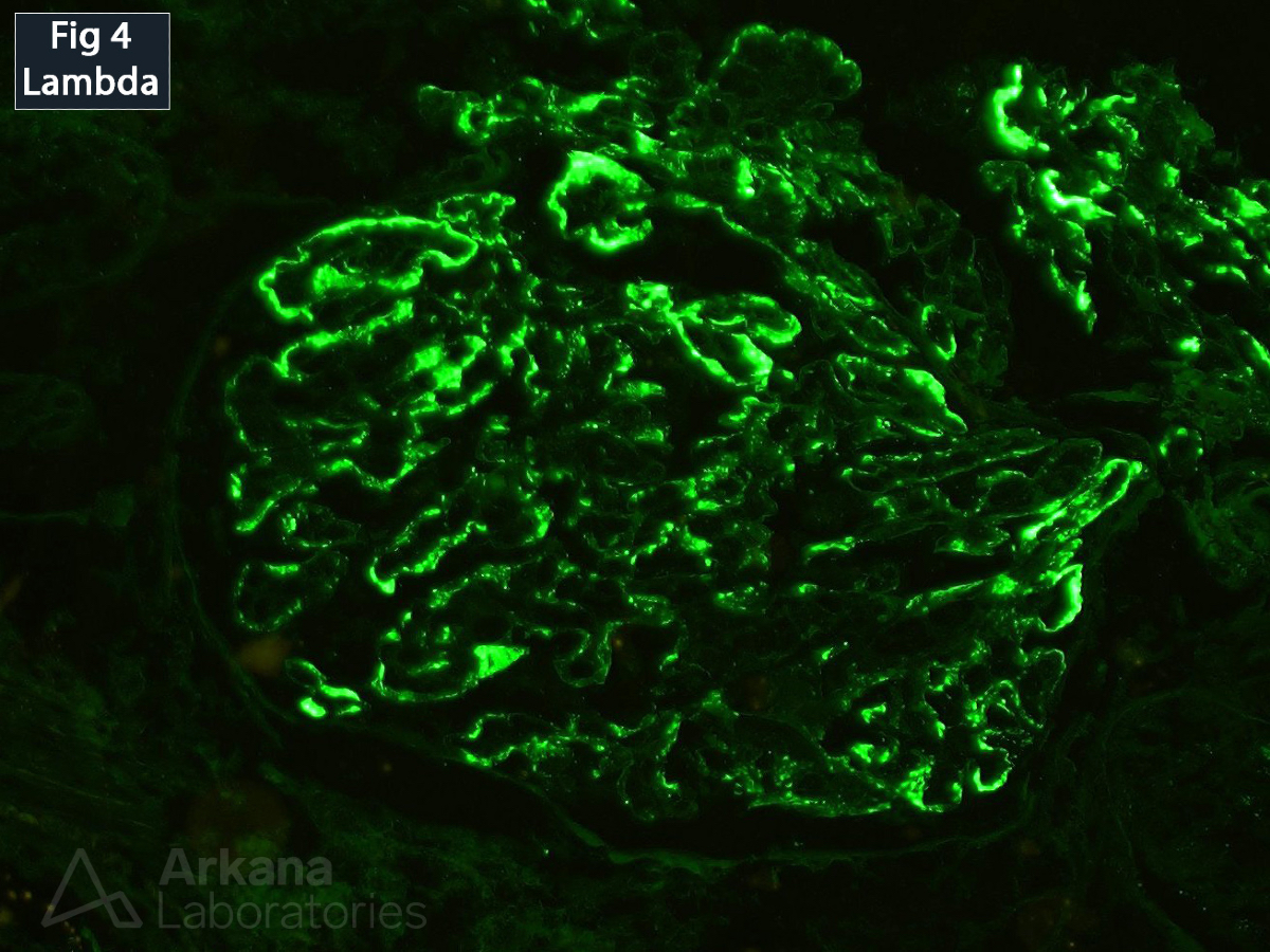 Arkana Laboratories (@arkanalabs) on Twitter photo This biopsy was performed on a 58 year old female who presented with mild proteinuria. The glomeruli show diffuse and global endocapillary hypercellularity with segmental double contour formation of the capillary loops on silver stain (Fig 1). Immunofluorescence shows mesangial This biopsy was performed on a 58 year old female who presented with mild proteinuria. The glomeruli show diffuse and global endocapillary hypercellularity with segmental double contour formation of the capillary loops on silver stain (Fig 1). Immunofluorescence shows mesangial