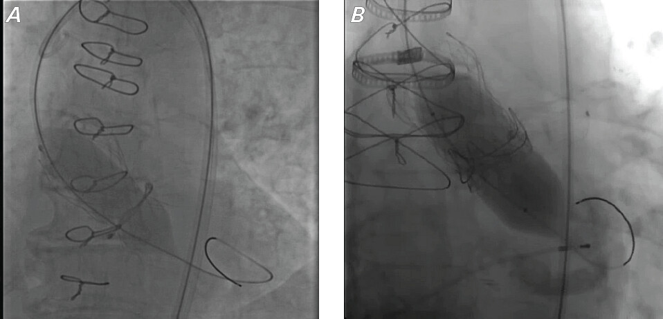 Texas_Heart's tweet photo. 📓 New from the #THIJournal 

Post-ViV-#TAVI fracturing can be performed safely in select patients to reduce patient-prosthesis mismatch and transvalvular gradients. 

Hallak, et al. evaluate the use of valve "fracking" in this case series: https://t.co/n9mZlM0yQ3
@osamahallak5 https://t.co/uIYUtRUPUX