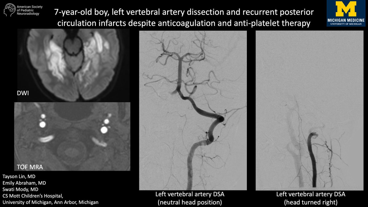 Case of the week: 7-year-old boy, left vertebral artery dissection and recurrent posterior circulation infarcts despite anticoagulation and anti-platelet therapy bit.ly/3VC1uTR Tayson Lin, MD, Emily Abraham, MD, Swati Mody, MD, CS Mott Children’s Hospital, University of