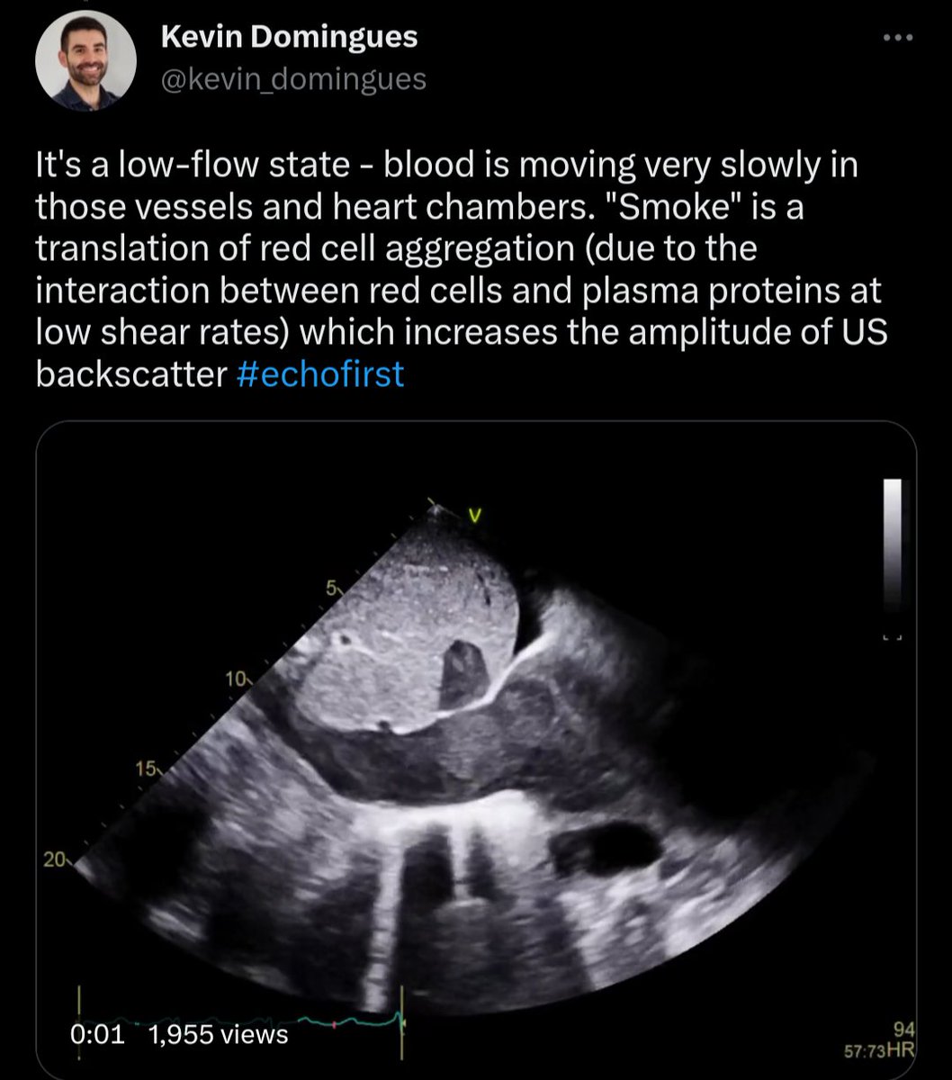 Shamsul_Hi's tweet photo. This is similar to Smoky apperance/spontaneous echo contrast in vessels/heart chamber. https://t.co/WagaX2haPH