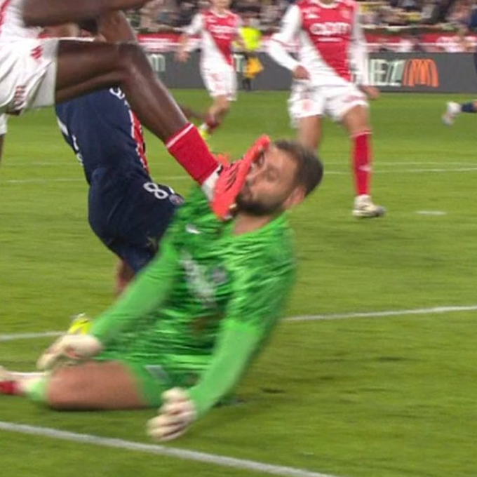 onedio's tweet photo. Monaco-PSG maçında Wilfried Singo'nun Donnarumma'ya yaptığı darbe sonucu yüzüne dikiş atılan Donnarumma, oyuna devam edemedi. https://t.co/Os0McdyQPQ