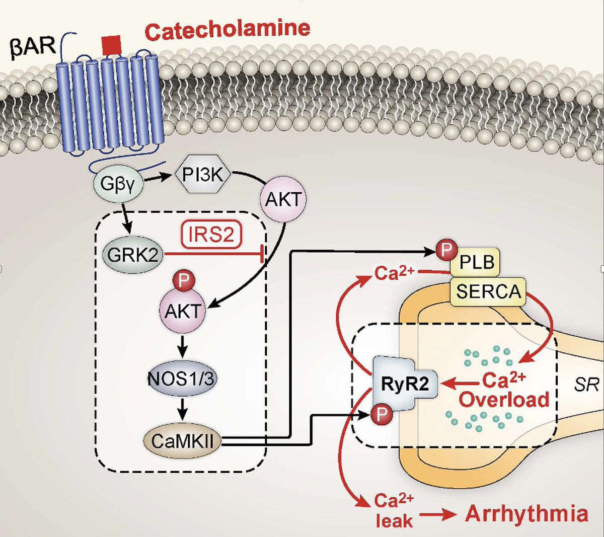 IntMedAbel's tweet image. Check out our latest publication in @CircAHA
@AHAScience with @LongShengSong1 & @qianshi_uiowa We show how Insulin Receptor Substrate (IRS2) when dysfunctional can lead to arrhythmias. Mechanism below. True in humans with germline mutations as well. ahajournals.org/doi/full/10....
