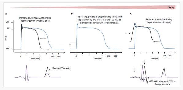 Now online in <a href="/NDTsocial/">NDT</a>

How hyperkalemia affects the heart: clinical implications 

🧐The ECG of hyperkalemia differs between AKI and CKD through the rate of IC/EC gradient  modification.

▶️academic.oup.com/ndt/article-ab…