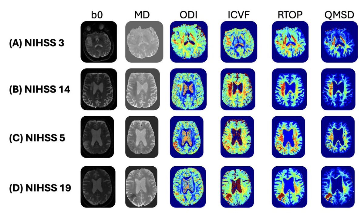 Niko Mouchtouris, MD (@niko_mou) on Twitter photo Our latest paper on the 3 key diffusion #imaging frameworks for ischemic #stroke is out! Mean apparent propagator (MAP) MRI only takes a couple minutes to process and has incredible potential! Great job to <a href="/juliadiamandi17/">Julia Diamandi</a> for leading this paper! authors.elsevier.com/a/1kGQV,GdM5rW… Our latest paper on the 3 key diffusion #imaging frameworks for ischemic #stroke is out! Mean apparent propagator (MAP) MRI only takes a couple minutes to process and has incredible potential! Great job to <a href="/juliadiamandi17/">Julia Diamandi</a> for leading this paper! authors.elsevier.com/a/1kGQV,GdM5rW…