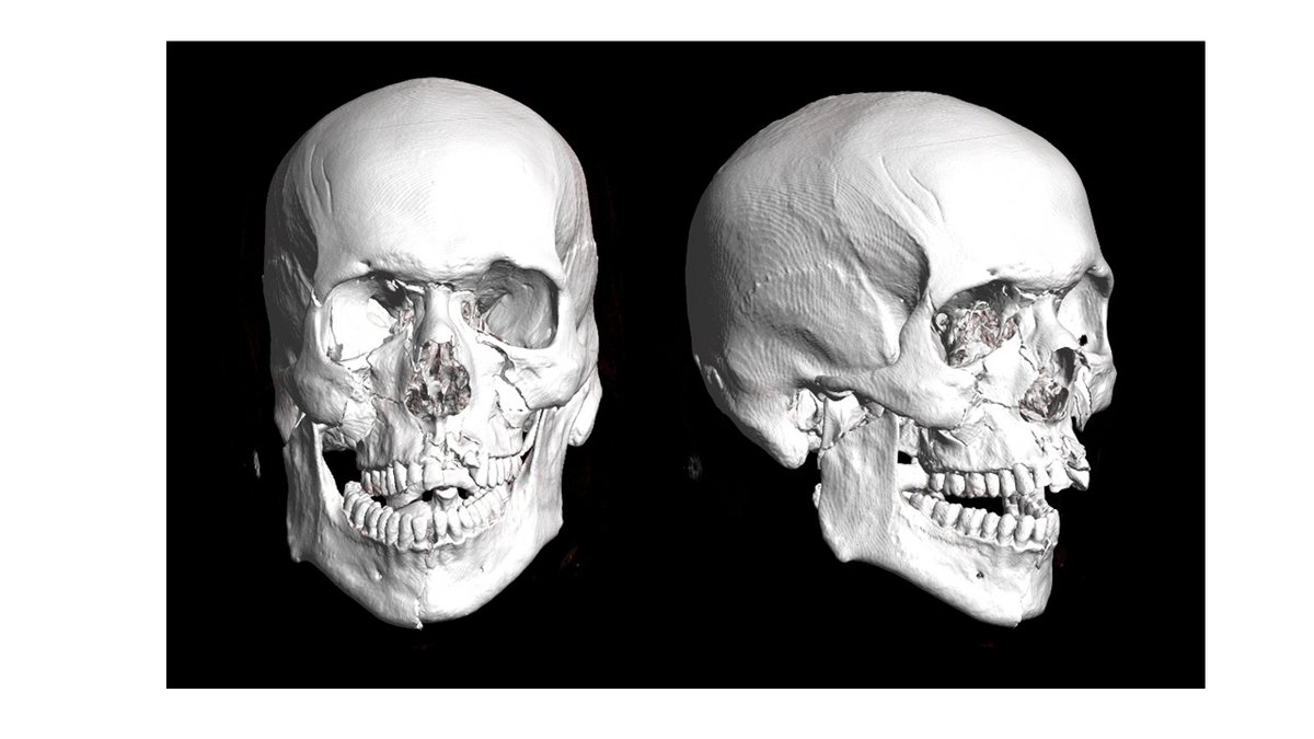 Intubación submentoniana como alternativa a la traqueostomía en traumatismo craneofacial grave: a propósito de un caso s.mtrbio.com/iizqxtuvuf
